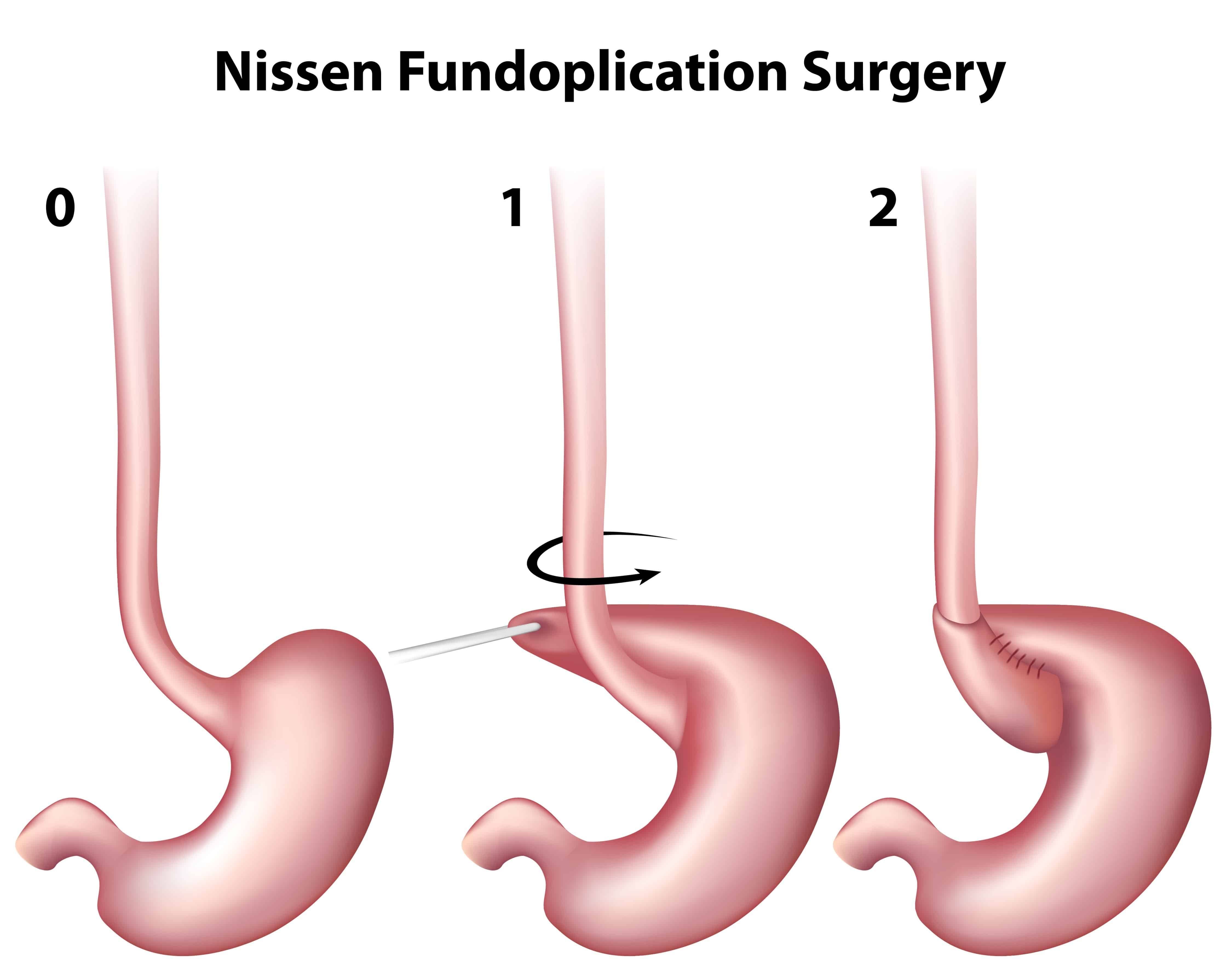 Esophageal Reflux - Dr. Angel M. Caban, MD - Linx Procedure